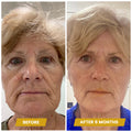 Liquid Facelift®